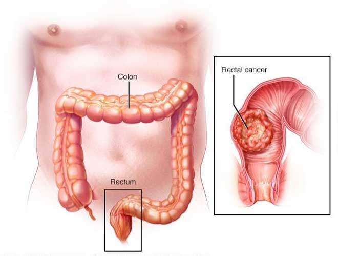 Nguyên nhân ung thư trực tràng: Những yếu tố nguy cơ và cách phòng tránh